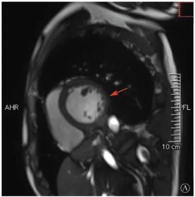 协和疑难︱第67例:临床表现胸痛伴肌酸激酶升高